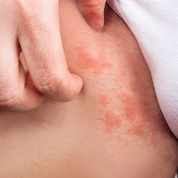 アレルギーとは